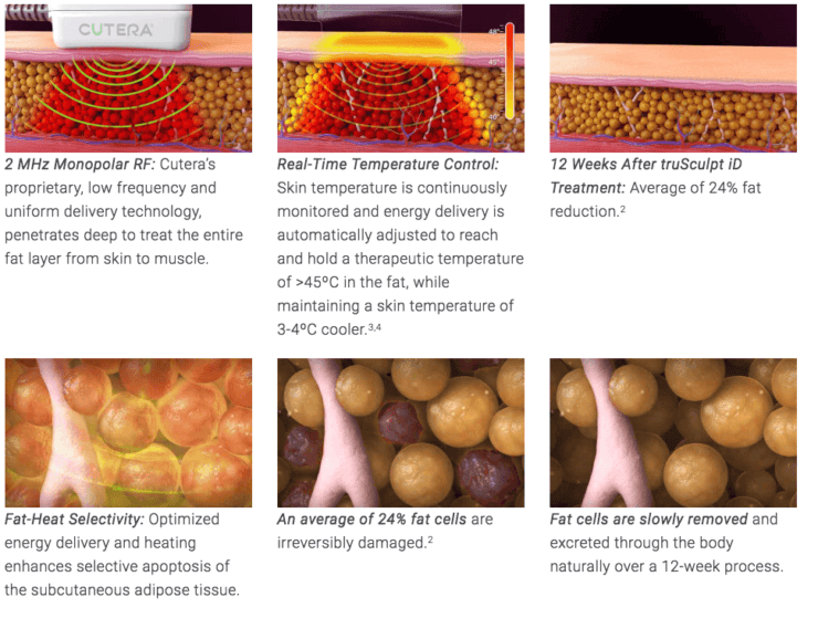 how does truSculpt ID work - hot sculpting technology