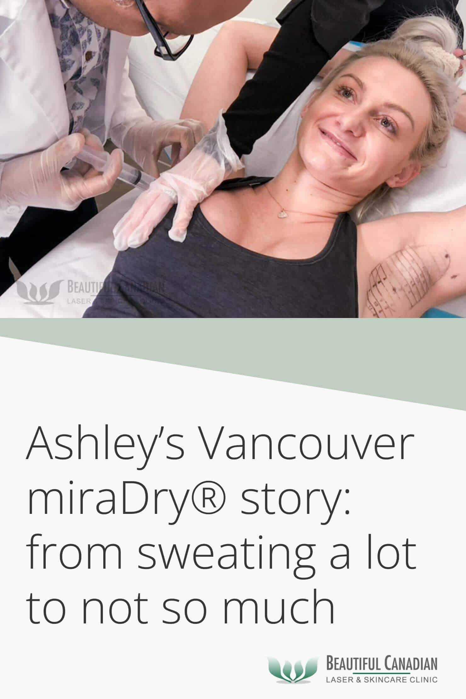 Ashley's miraDry sweat treatment story - from sweating a lot to not so much - article pinterest image 