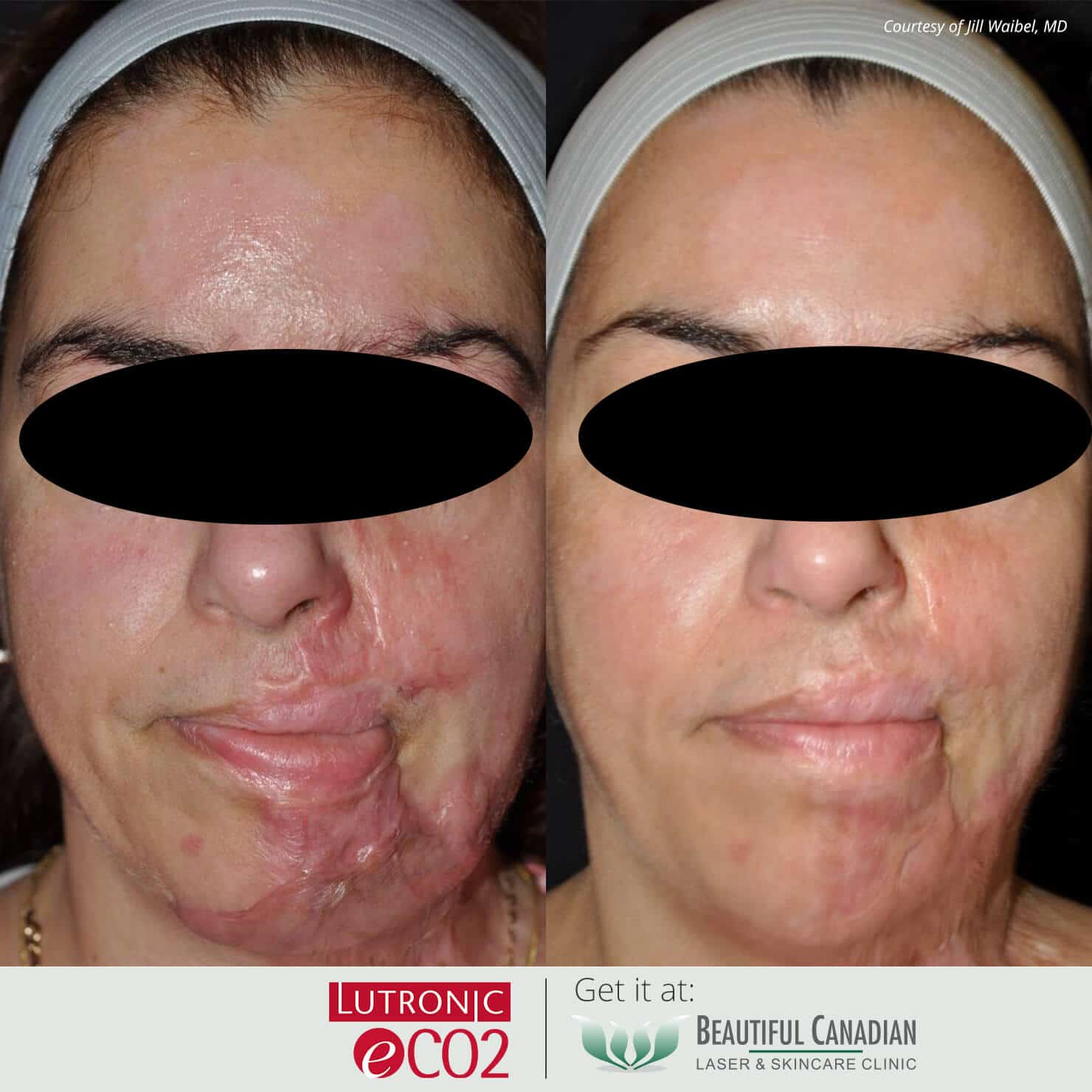 before and after image of CO2 laser skin resurfacing on burn patient - treatment available in Surrey