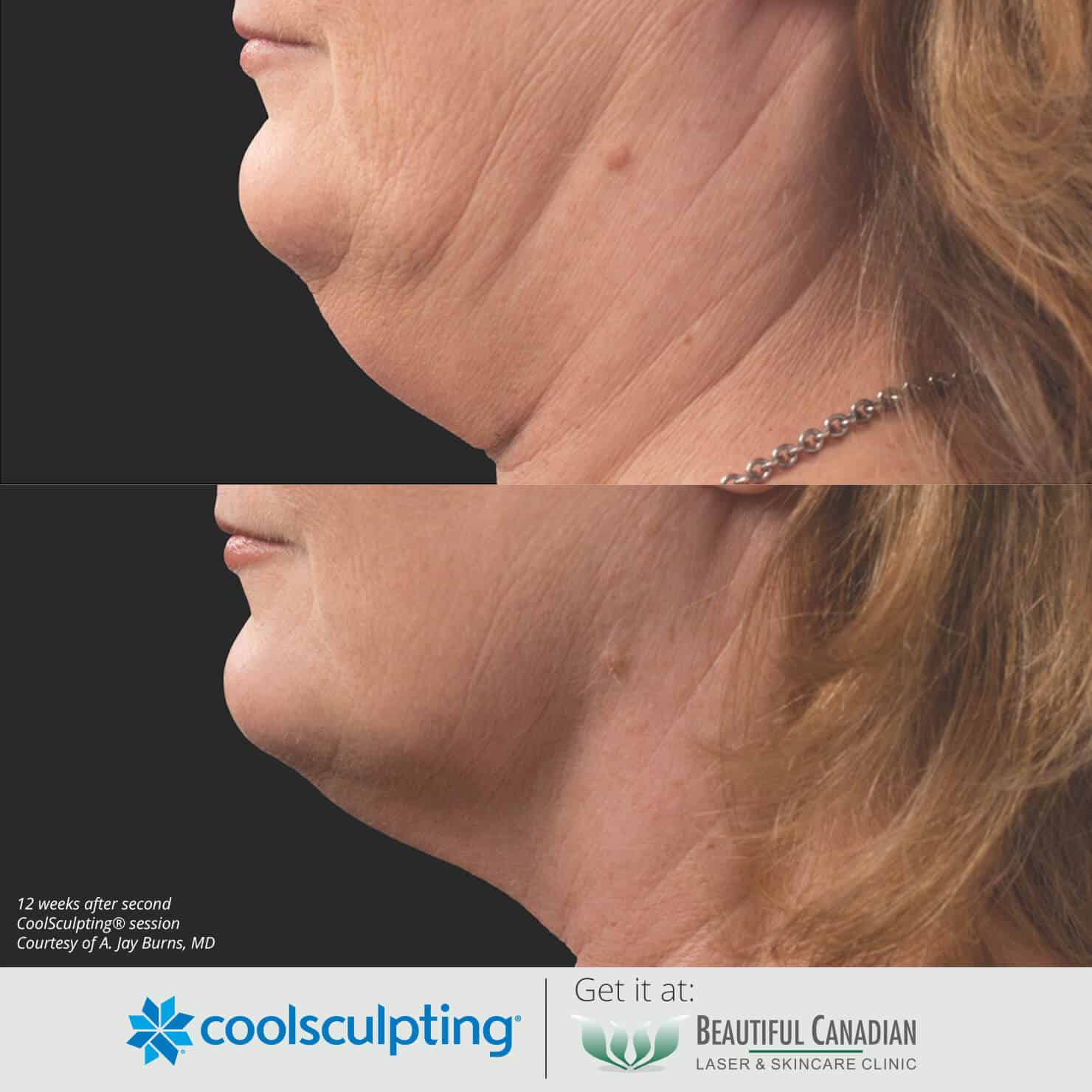 CoolSculpting results of female double chin fat removal before and after side view