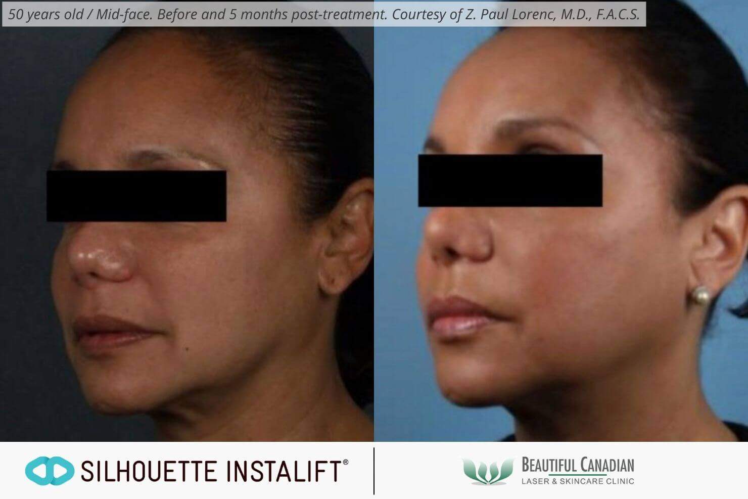 Before and after of Silhouette Instalift thread lift for jowls and nasolabial folds - available in Vancouver Surrey