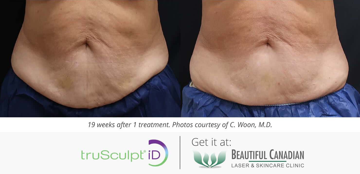 hot sculpting skin tightening and fat reduction before and after with trusculpt ID - available in Vancouver