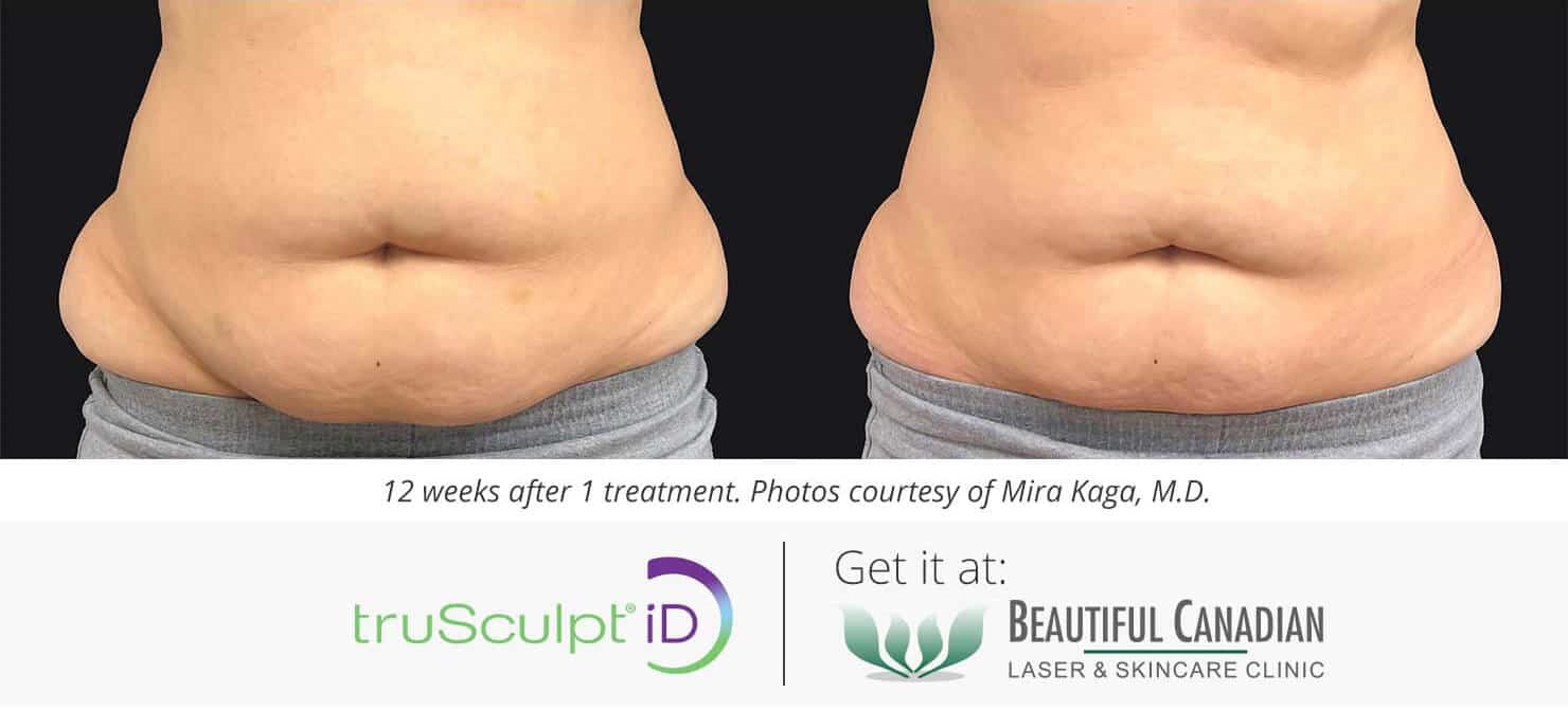 hot sculpting with trusculpt ID before and after - belly fat reduction - available in Vancouver