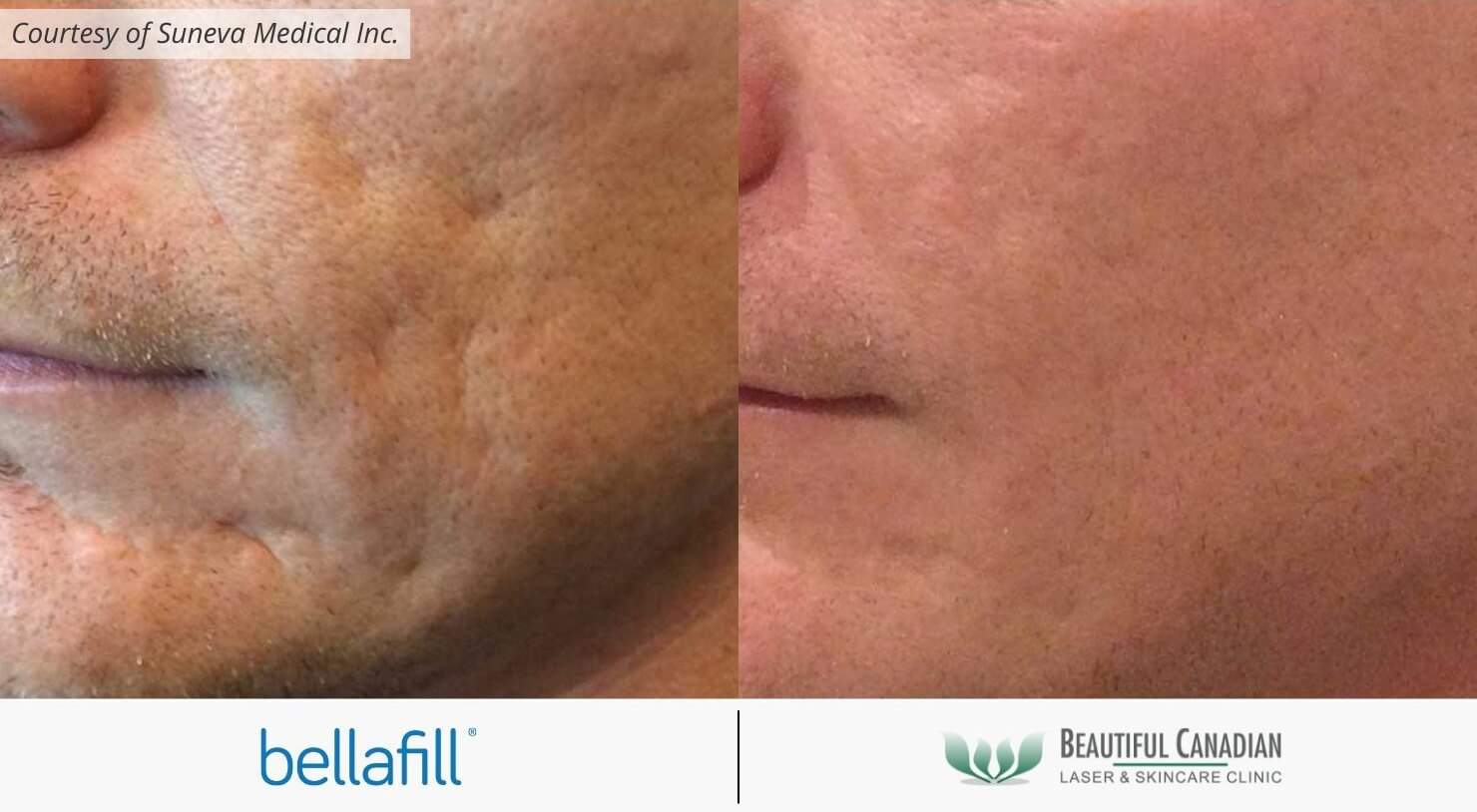 Bellafill acne scar treatment before and after