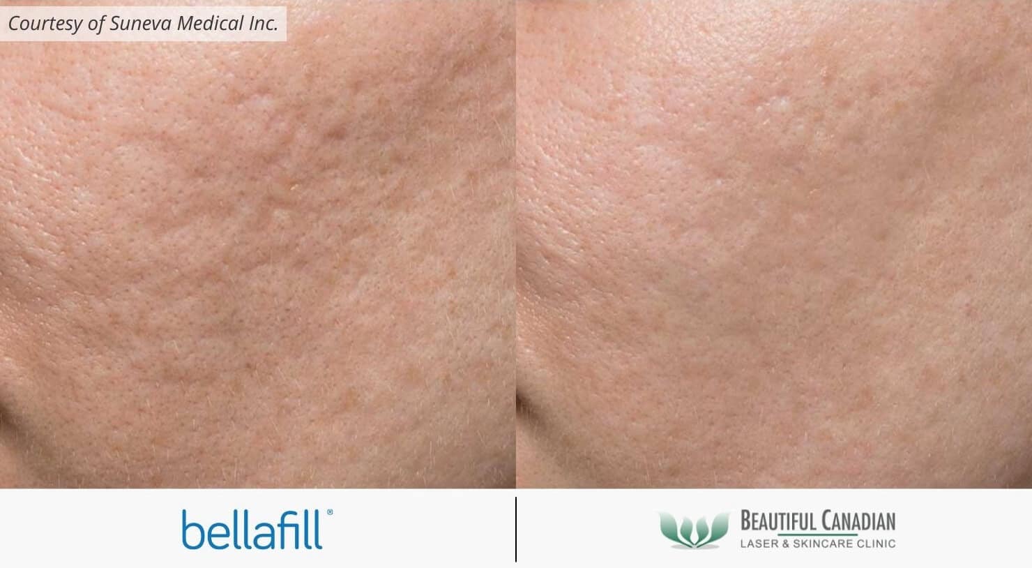 Acne scar filler treated with Bellafill dermal filler - before and after