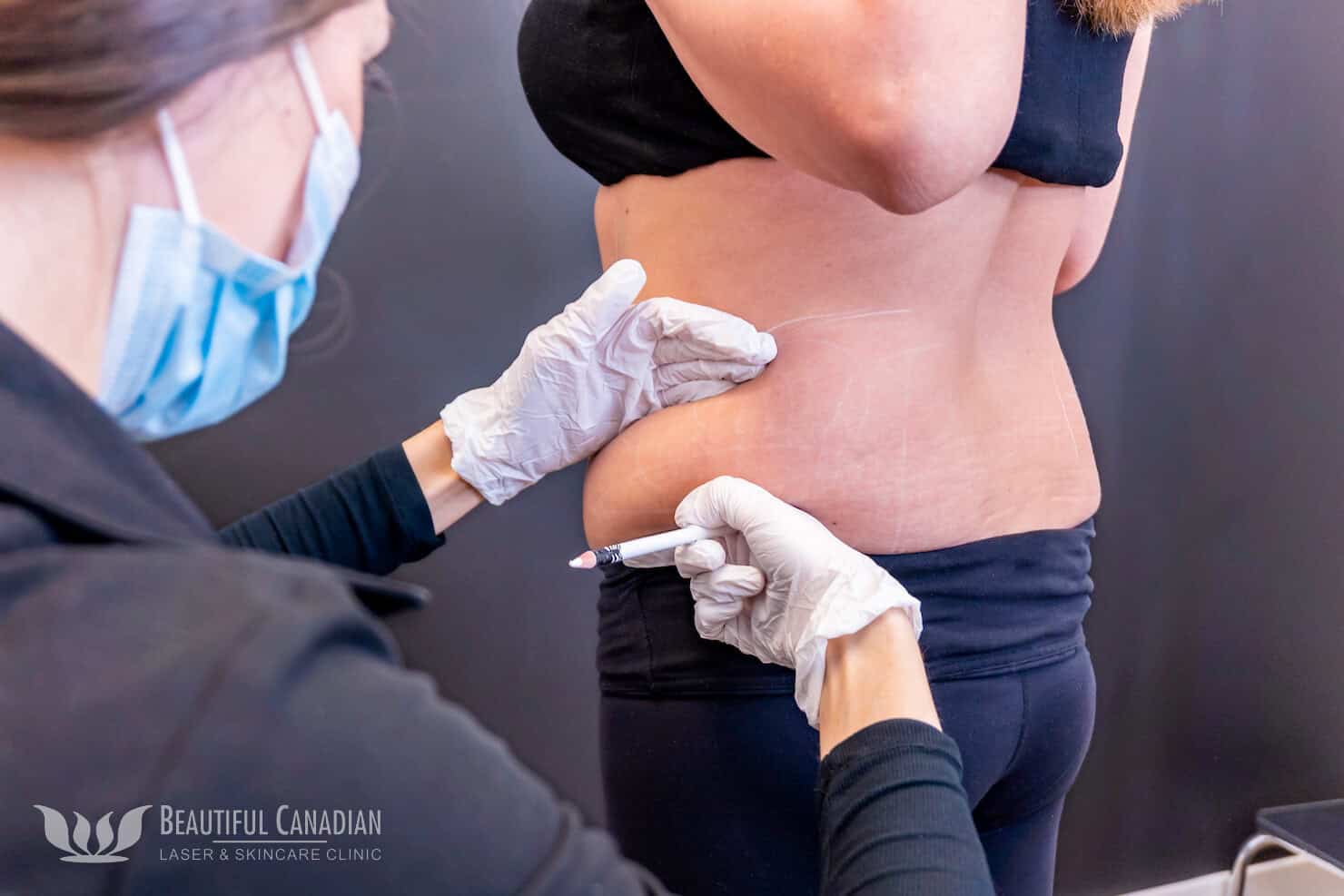 Vancouver body contouring consultation on love handles - marking treatment area