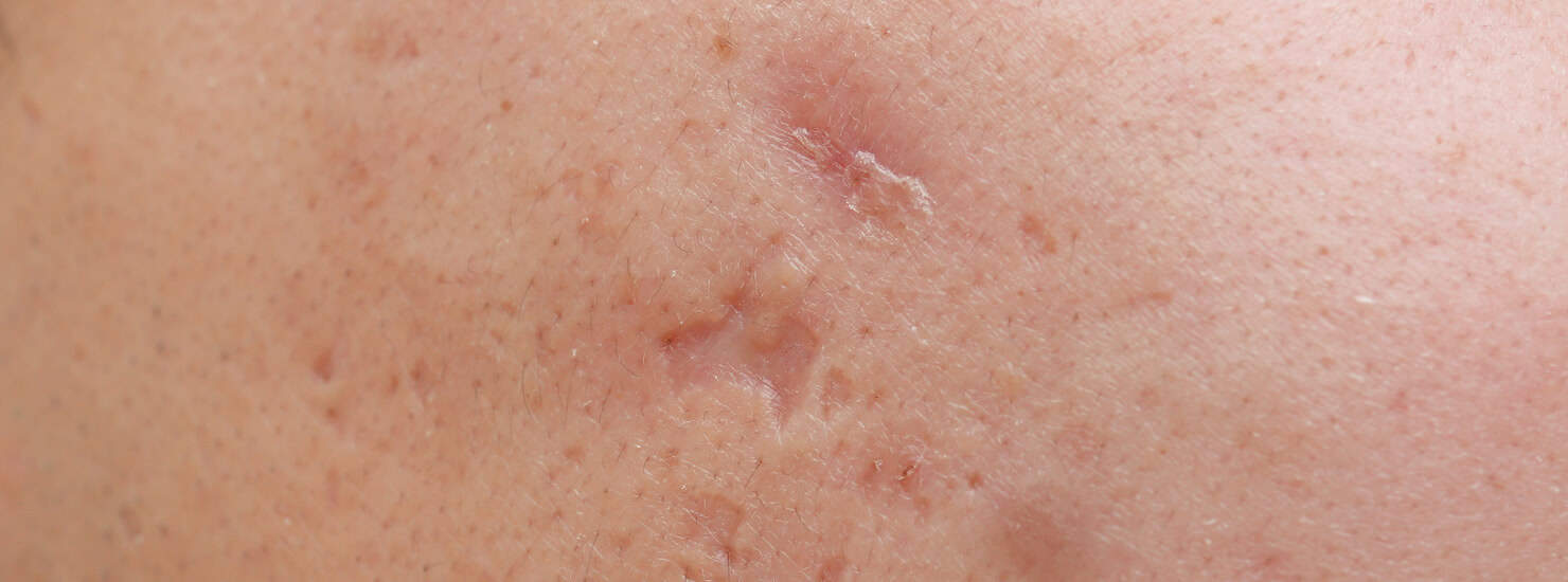 Acne boxcar scar indented and with an uneven shape - requires acne scar treatment