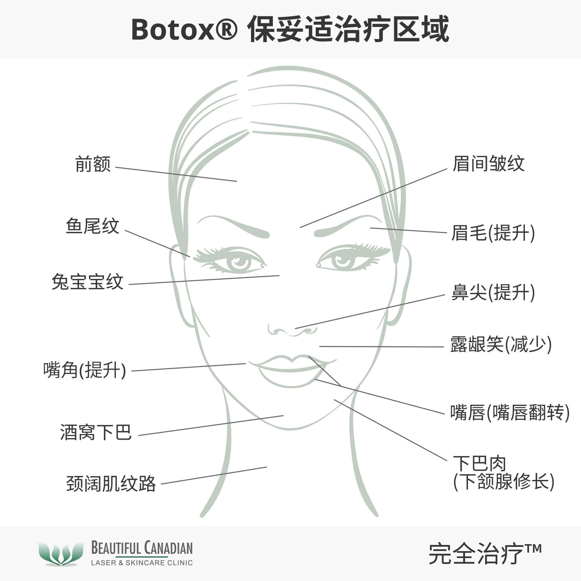 Botox® 保妥适治疗区域