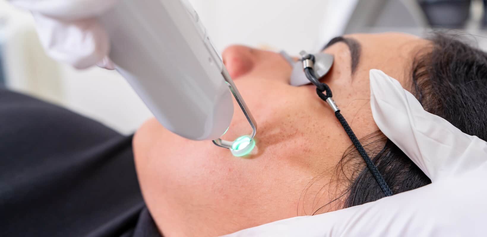 Surrey laser acne treatment with Clarity laser side view