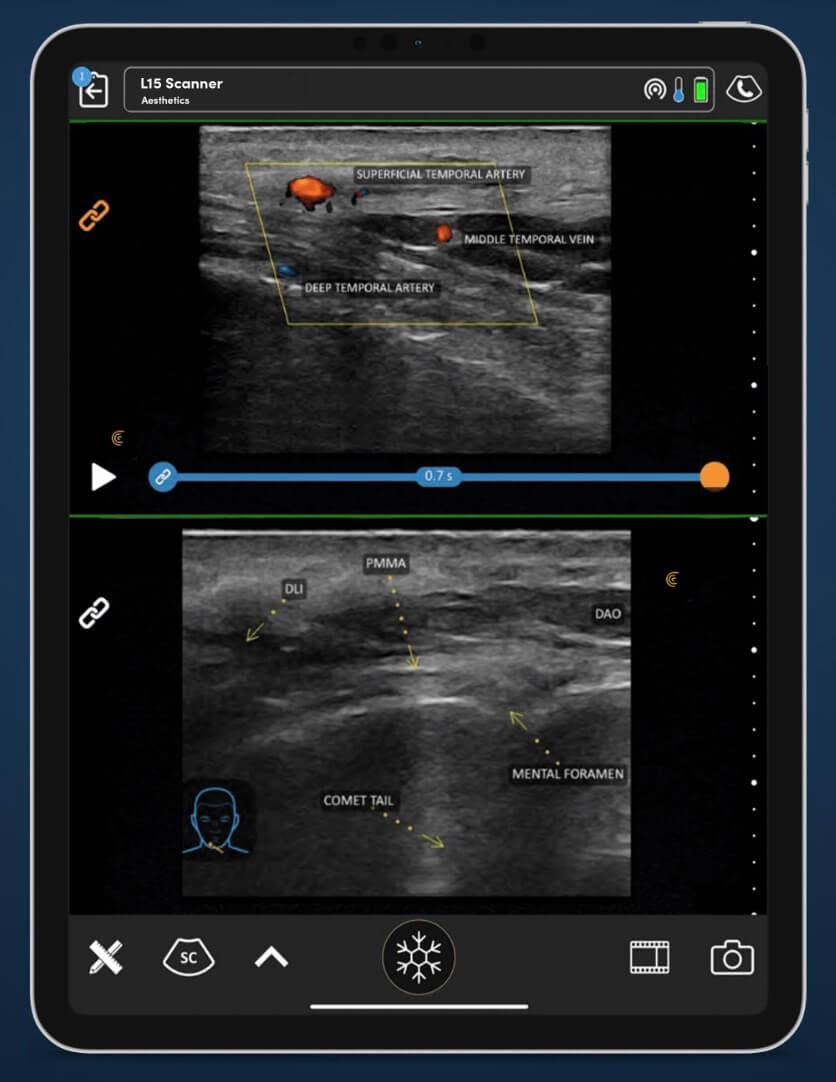 Clarius ultrasound scan imaging on app for dermal filler treatments