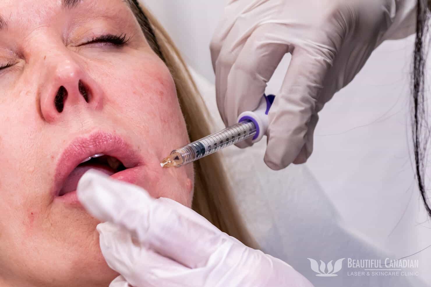 Closeup of Surrey lip filler treatment with Juvederm