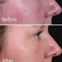 Colorescience All Calm Clinical Redness Corrector with SPF - Redness Face Cream - Before and After Results - set 1