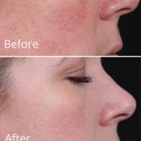 Colorescience All Calm Clinical Redness Corrector with SPF - Redness Face Cream - Before and After Results - set 2