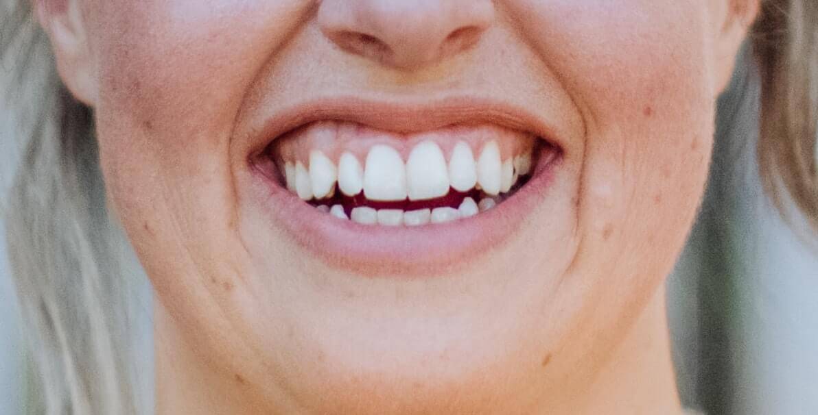 Gummy smile close up - adjustable with Botox in Vancouver Surrey