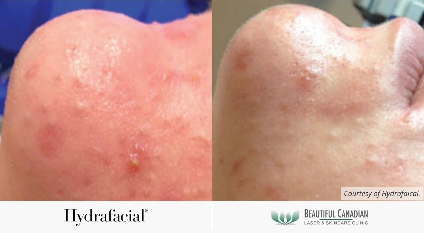 Hydrafacial before and after showing oily skin cleansed and inflammation reduced