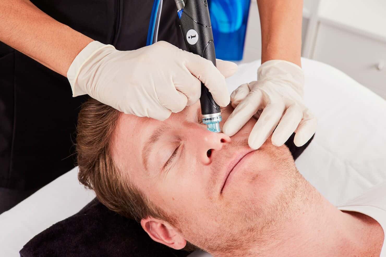 Hydrafacial procedure on male patient showing blue tip for pore extraction