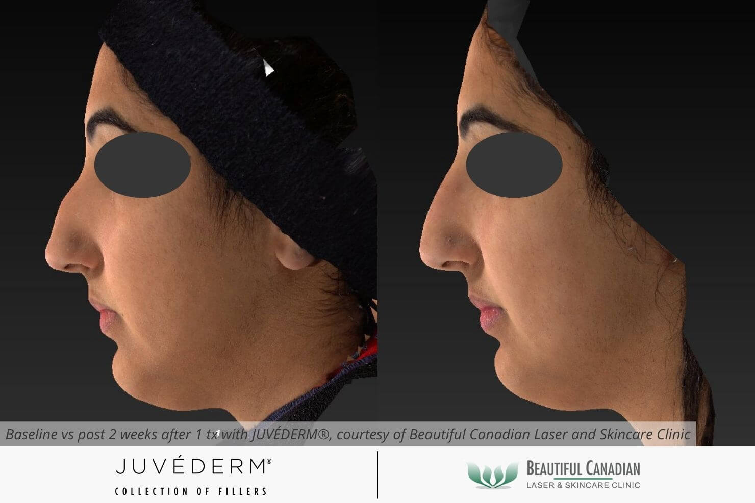 Non-surgical nose job before and after in Surrey BC