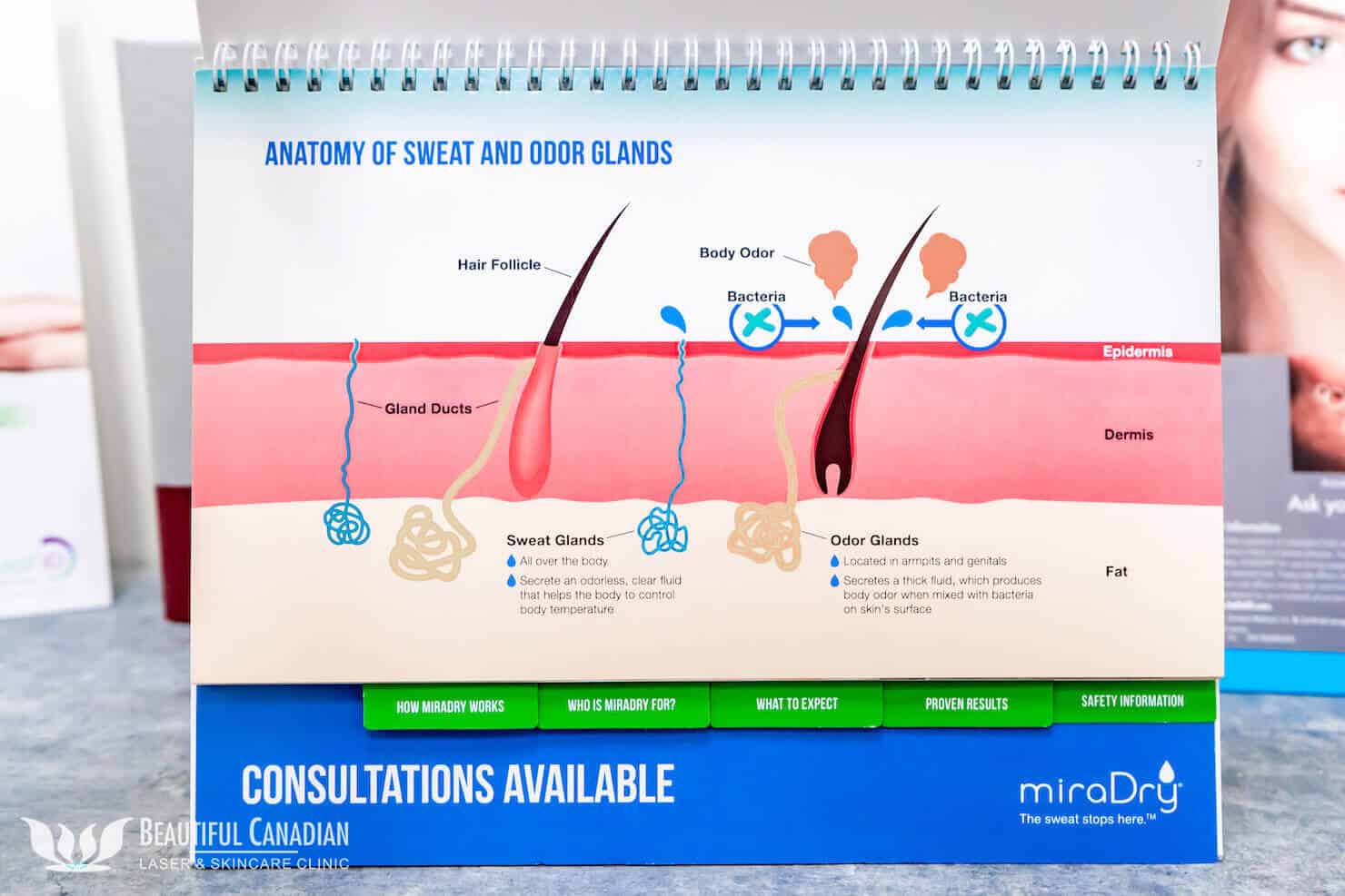 miradry in surrey pamphlet showing diagram of underarm sweat glands and odour glands