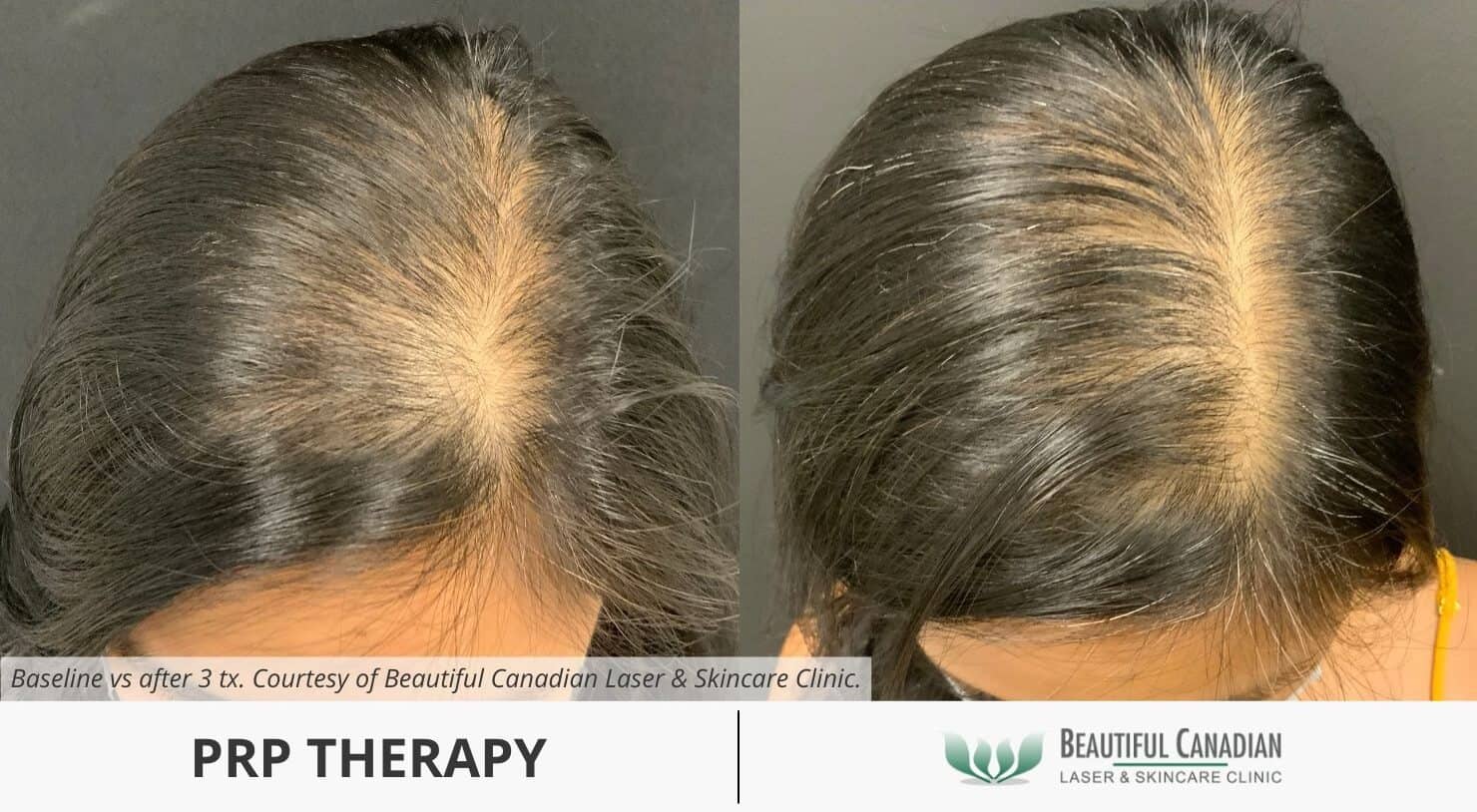 Surrey PRP therapy before and after for hair loss on female scalp