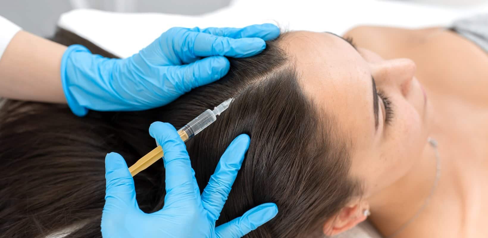 PRP therapy on scalp for hair loss treatment