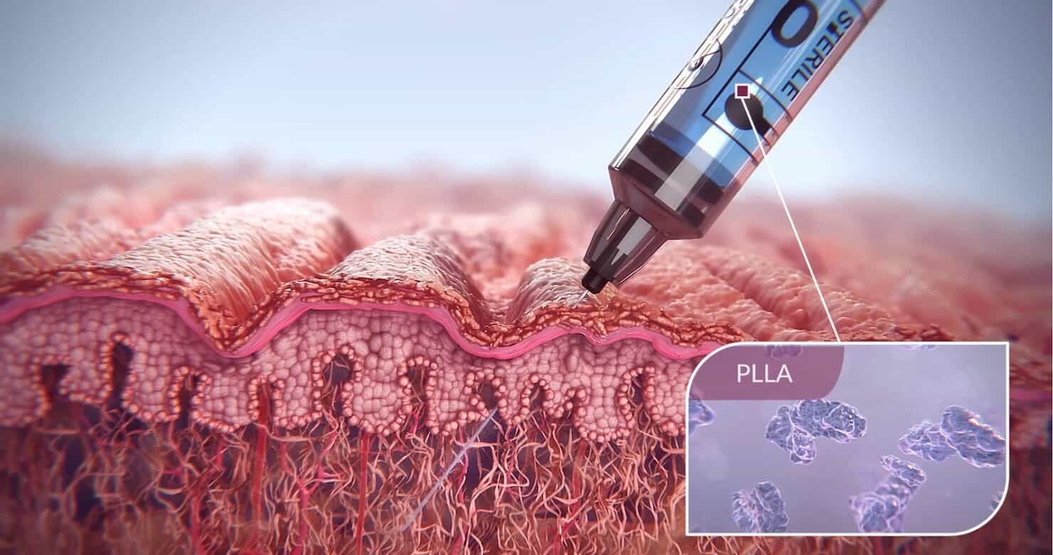 Sculptra dermal filler diagram being injected into skin - available in Vancouver