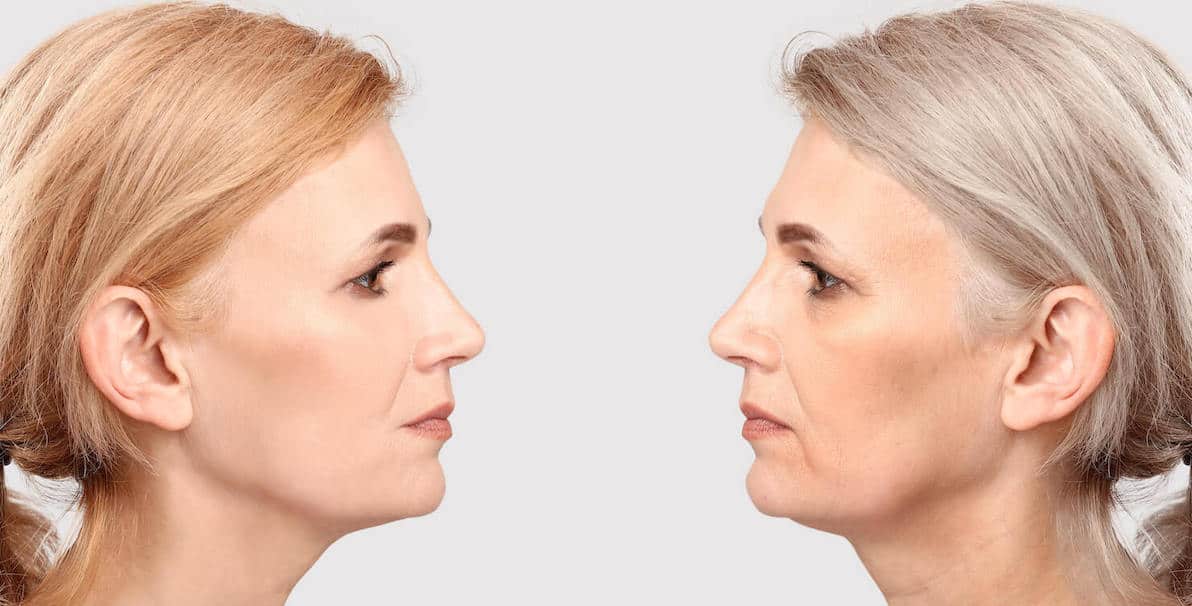 side by side after and before of face shape sagging jowl and chin treatment