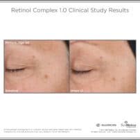 SkinMedica Before and After photo of Retinol Complex 1.0 - high end skincare results from clinical study