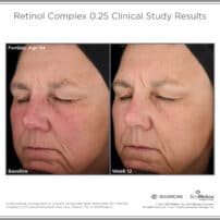 SkinMedica Before and After photo of Retinol Complex .25 - high end skincare results from clinical study