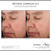 SkinMedica Before and After photo of Retinol Complex .5 - high end skincare results from clinical study
