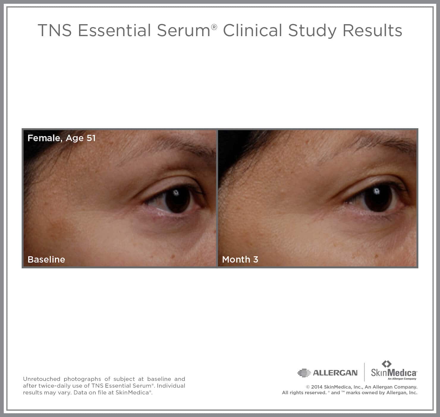 SkinMedica Before and After photo of TNS Essential Serum - high end skincare results