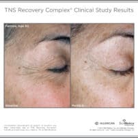 SkinMedica Before and After photo of TNS Recovery Complex - high end skincare results from clinical study