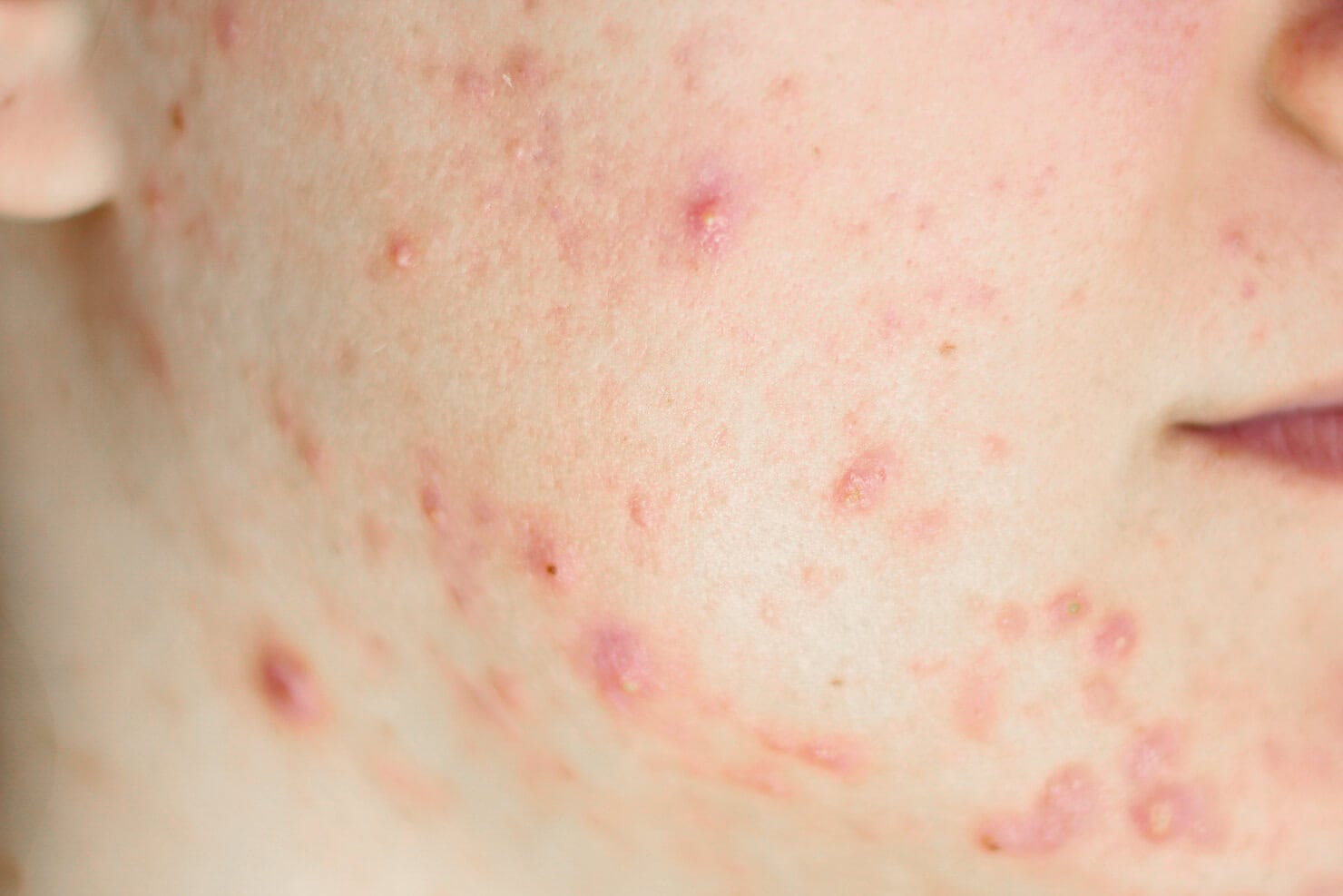 Stage 2 or 3 acne with white heads and pimples on face
