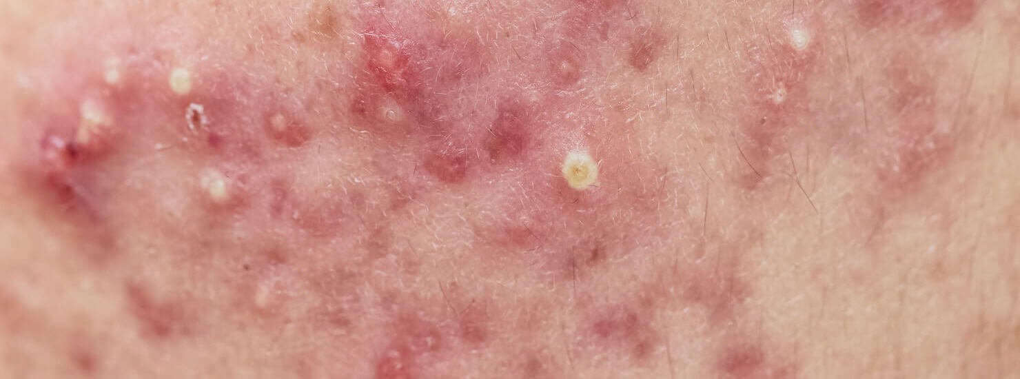 Stage 4 acne with nodules and cysts and large white heads plus macular acne scars and redness