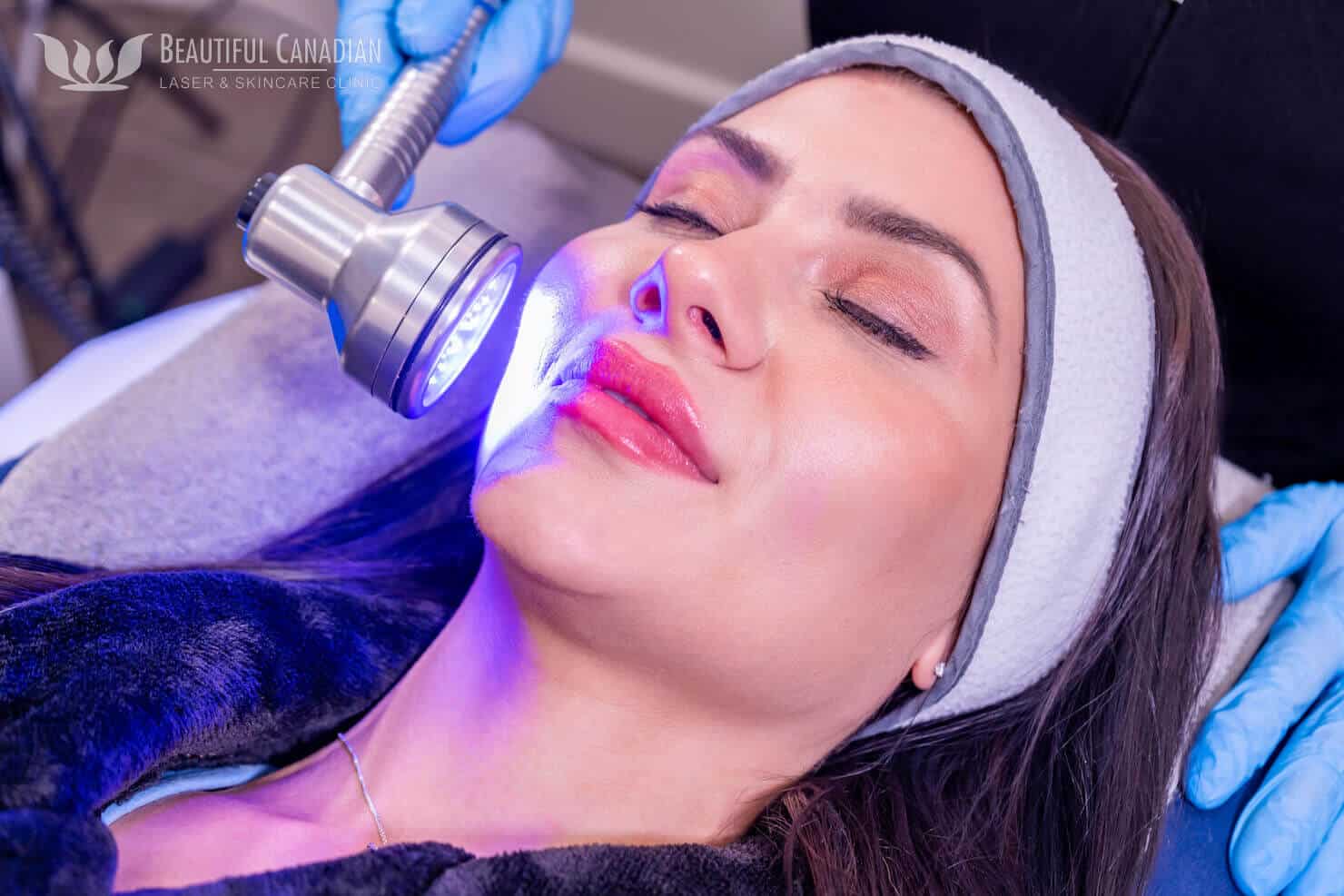 Surrey hydrafacial blue light therapy on female patient - can be used as photodynamic acne therapy