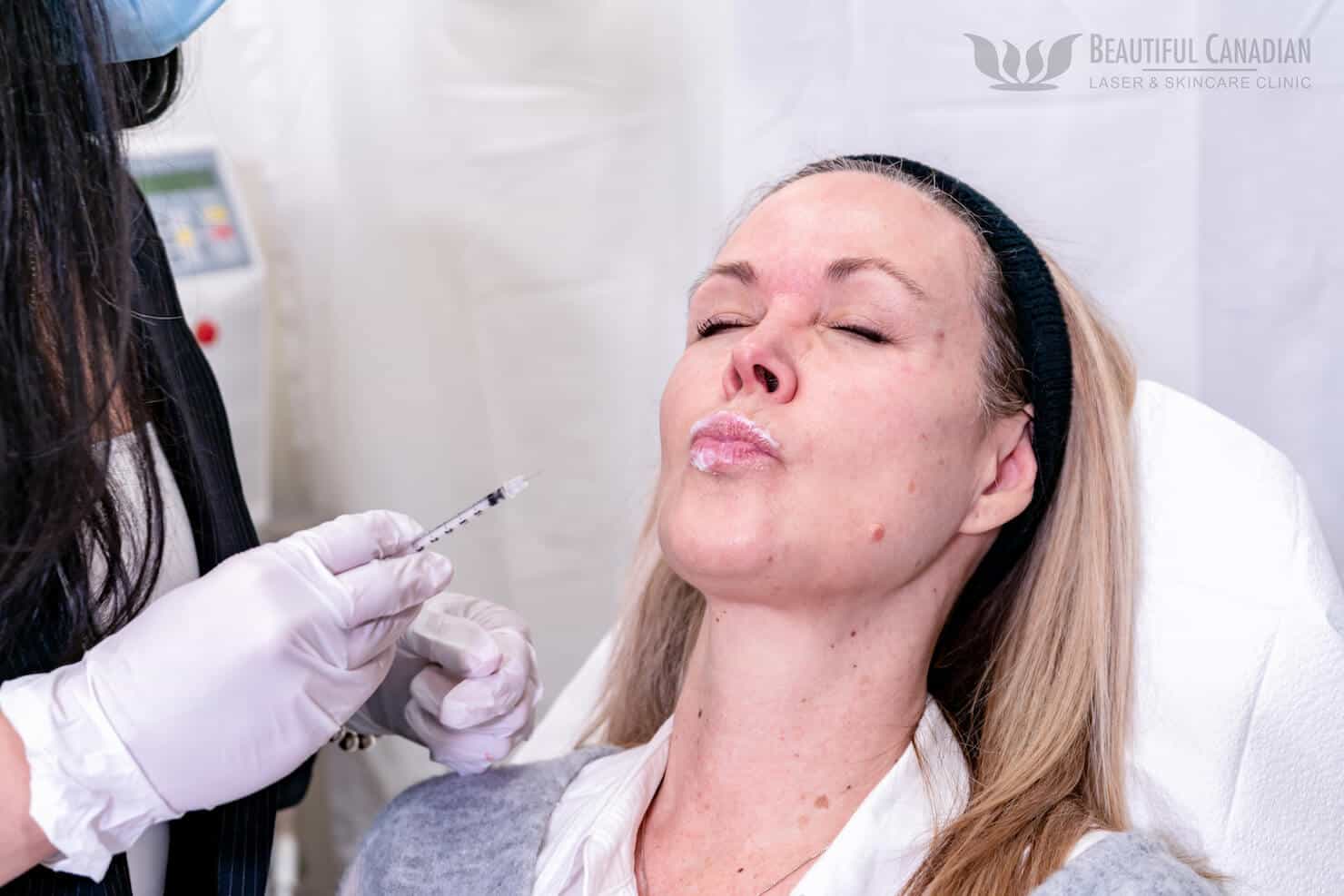 Vancouver Botox lip flip on female patient - making pout