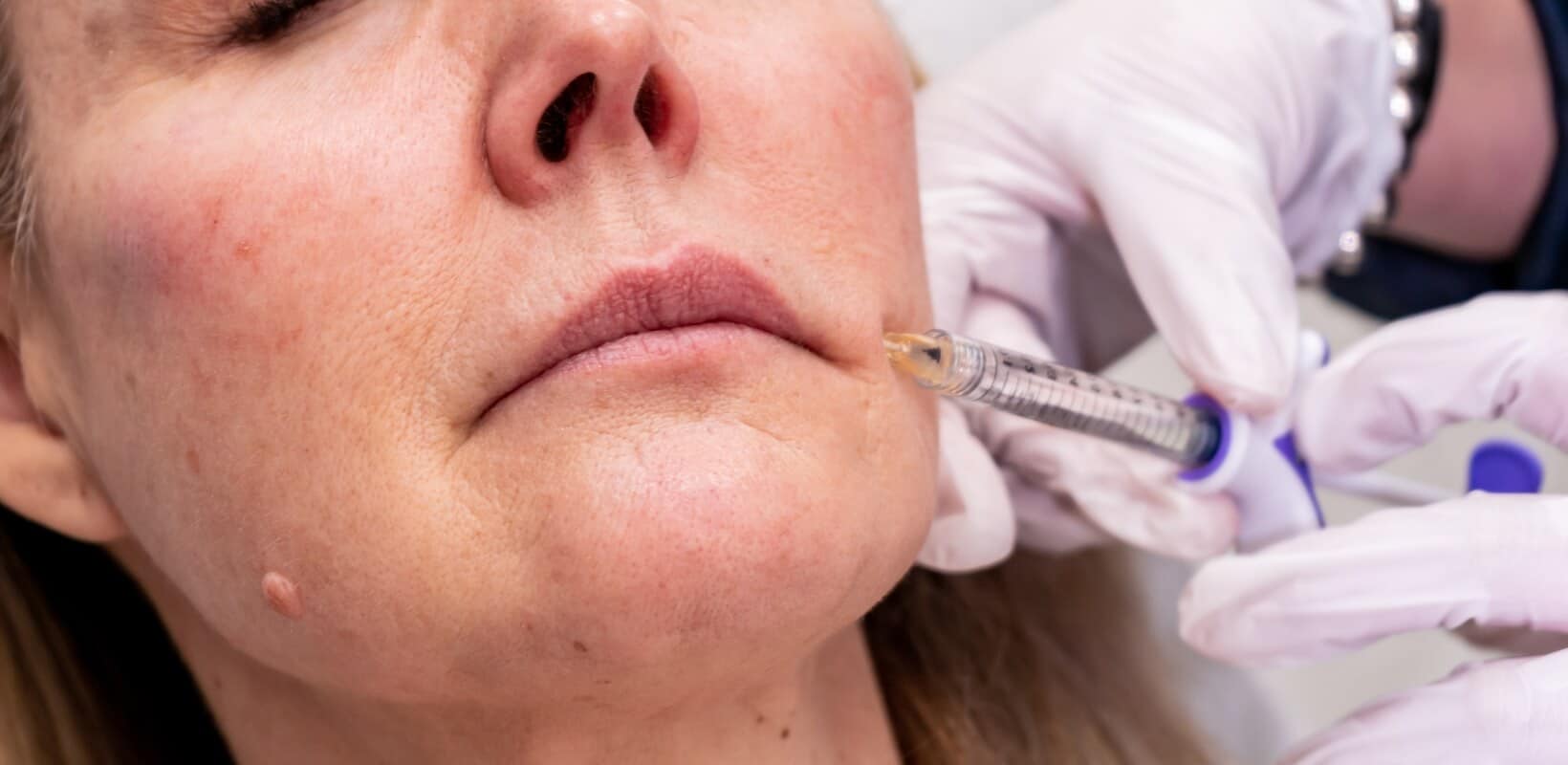 Surrey lip filler injection procedure close up