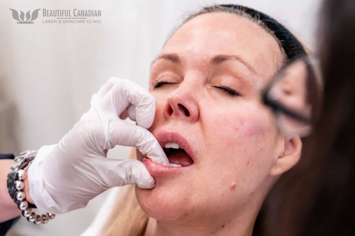 Vancouver lip filler procedure massaging lips - Surrey clinic