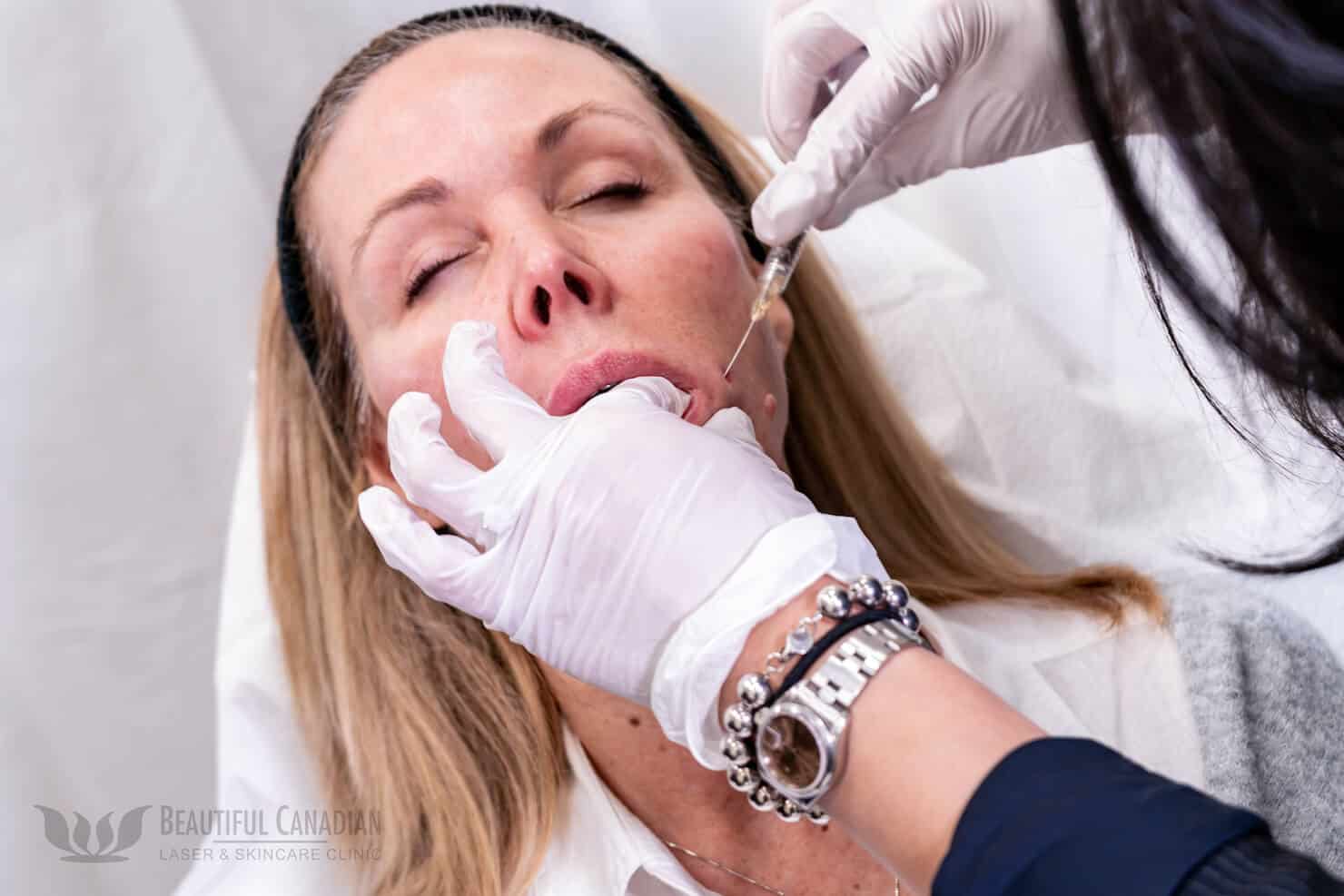 Vancouver lip filler treatment with cannula angled down and doctor feeling lips