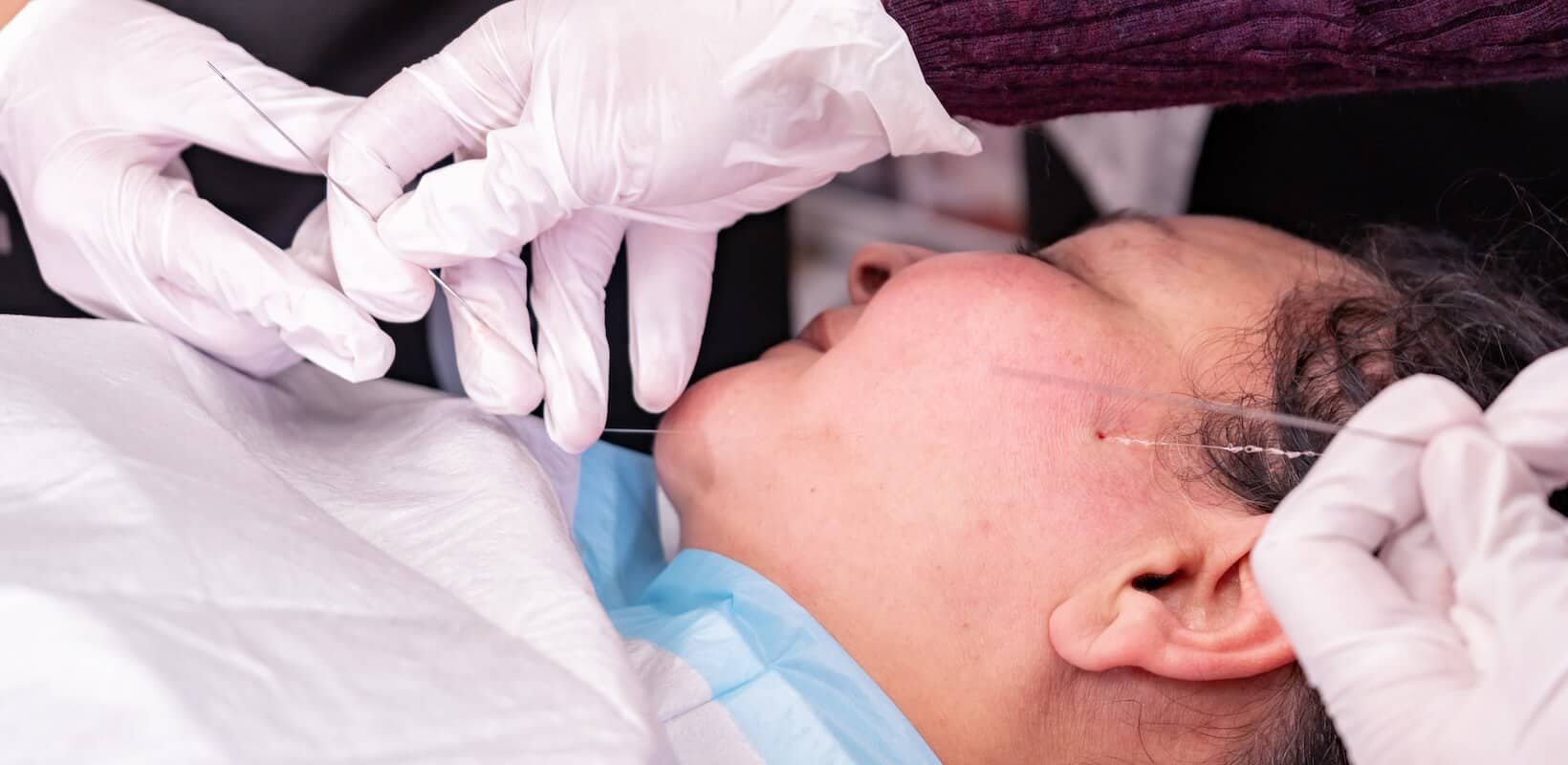 Vancouver thread lift procedure - threading through