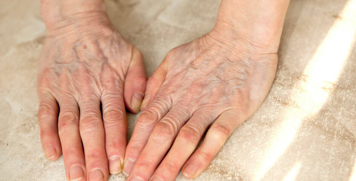 Veiny hands and wrinkled hands on aging skin - treatable with dermal filler in Surrey near Vancouver