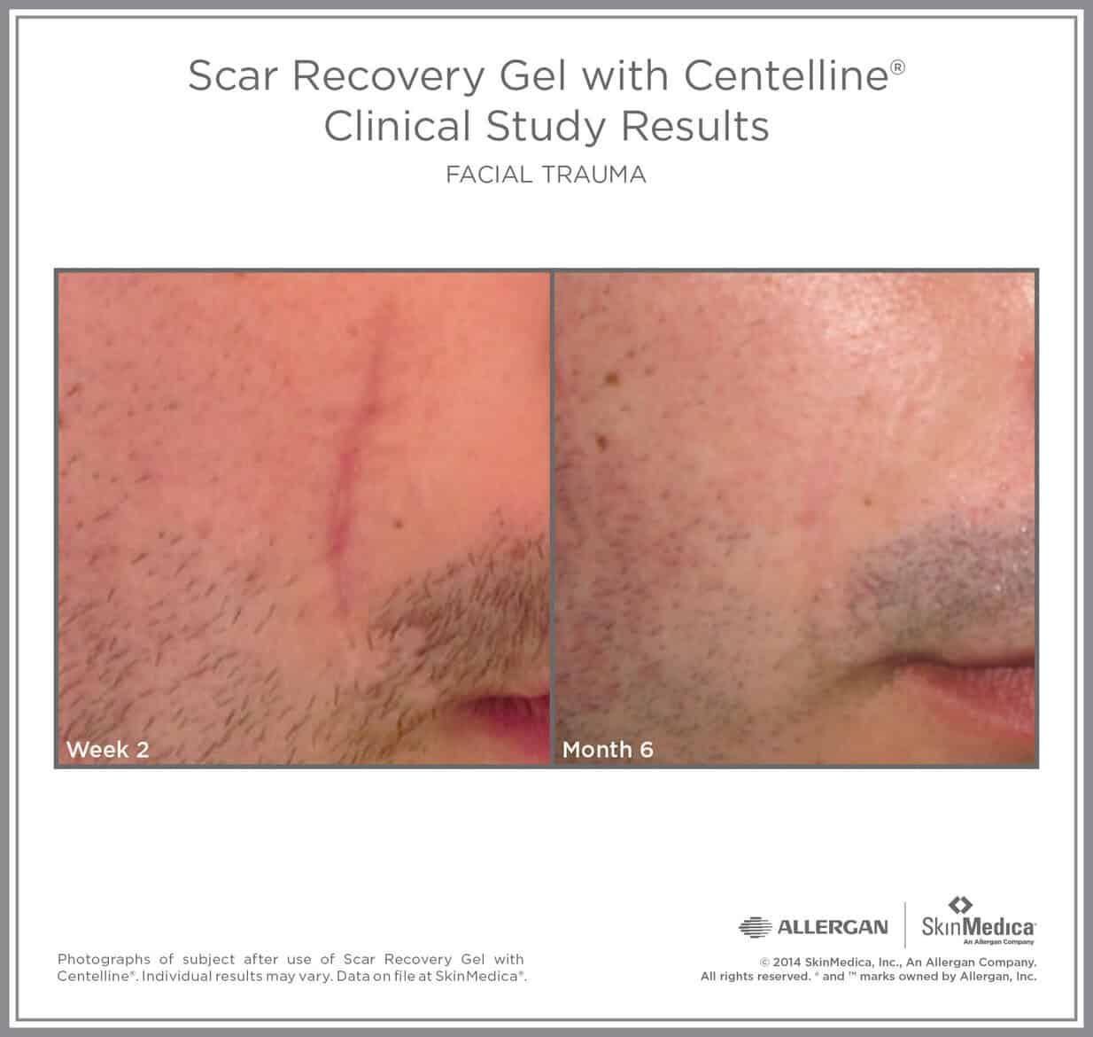 SkinMedica Scar Recovery Gel before and after facial scar - product available in Canada