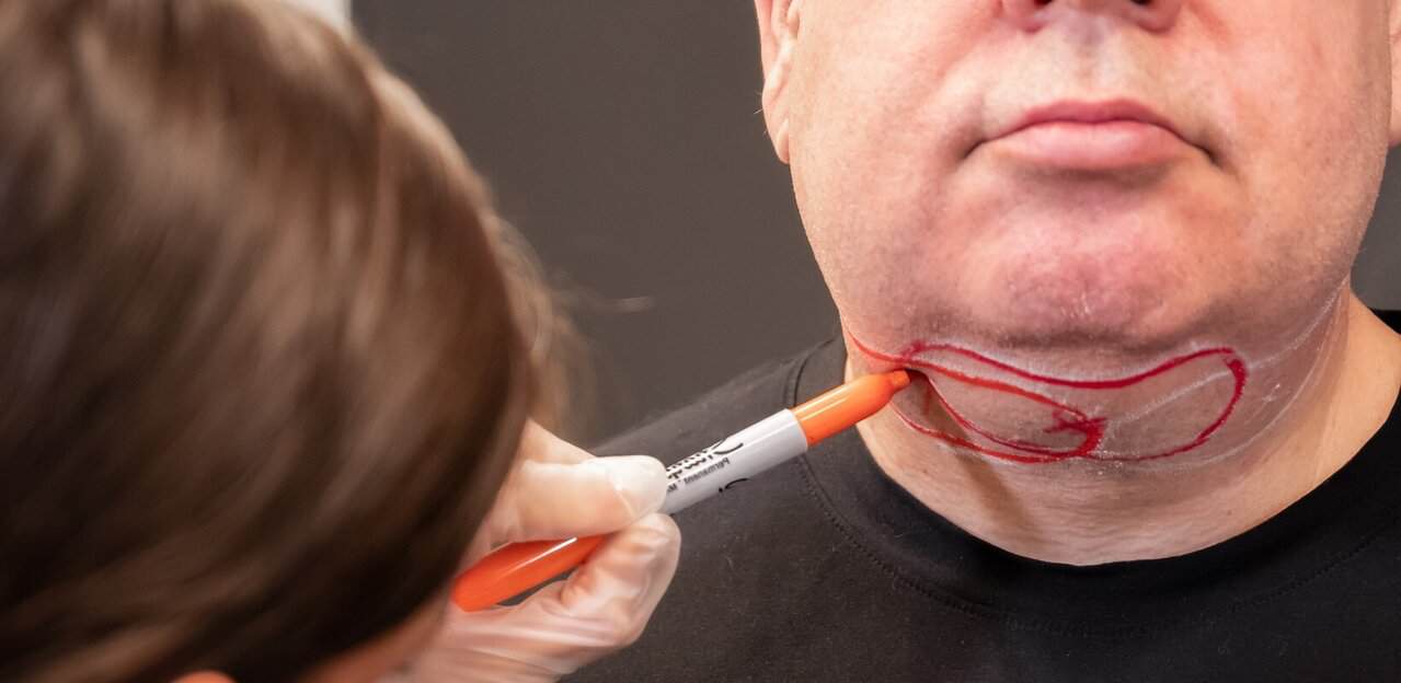Surrey CoolSculpting tracing for double chin removal