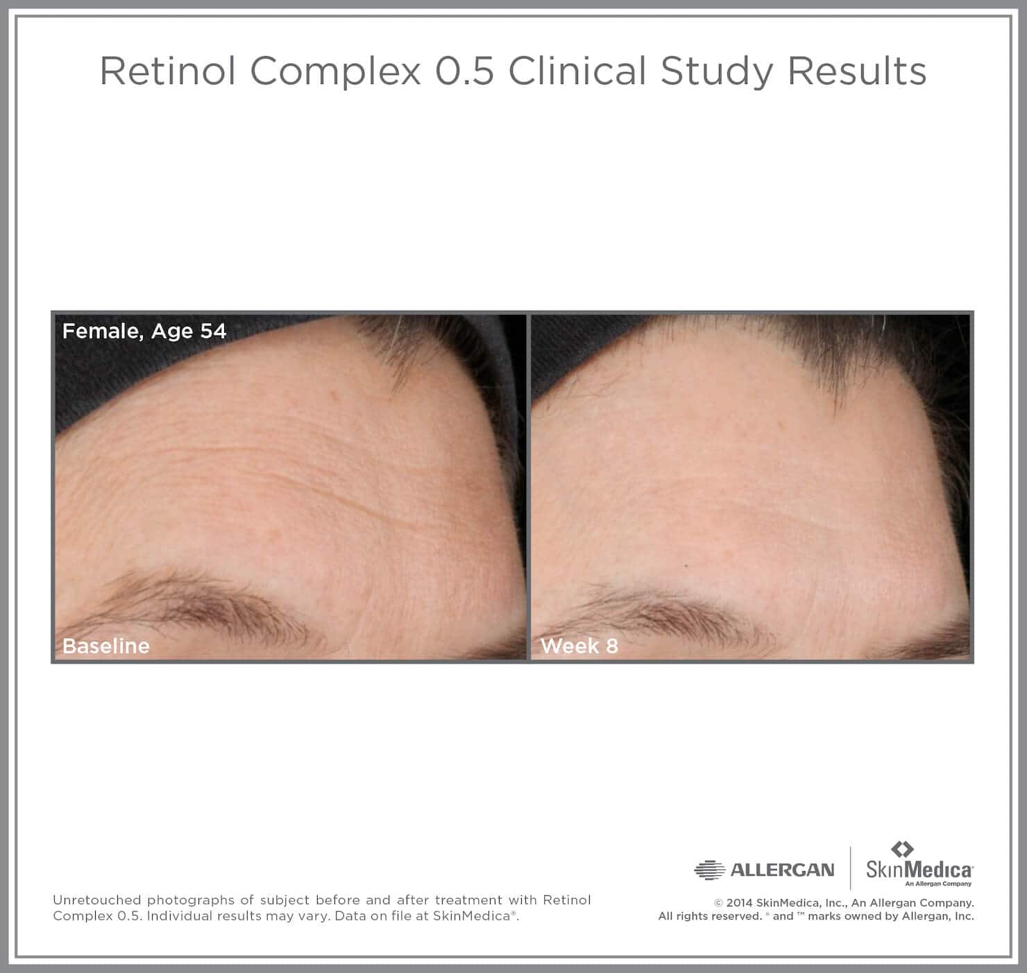 SkinMedica Before and After photo of Retinol Complex .5 - high end skincare results from clinical study