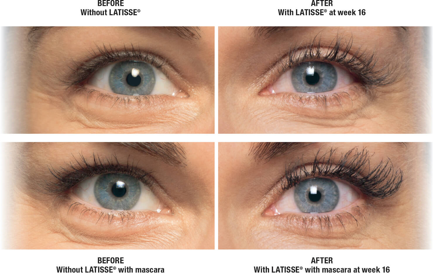 Latisse before and after results - amy - eyelash growth serum usage