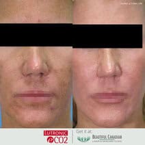 Before and after images of CO2 laser skin rejuvenation on aging skin - available in Vancouver