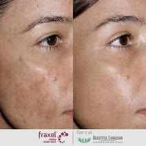 Before and after photos of hyperpigmentation treatment using the Fraxel laser - available in Vancouver