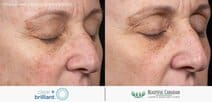 Clear + Brilliant laser skin rejuvenation before and after - female redness treatment - available in Surrey BC near Vancouver