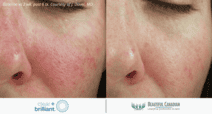 Clear + Brilliant before and after laser facial for redness - 2 weeks post 6 treatments - available in Surrey BC near Vancouver