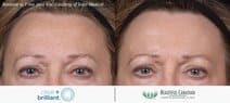 Clear + Brilliant before and after laser facial for forehead hyperpigmentation - 1 month post 6 treatments - available in Surrey BC near Vancouver