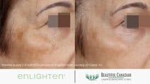 Enlighten pico genesis hyperpigmentation treatment before and after brown spot - available in Vancouver Surrey